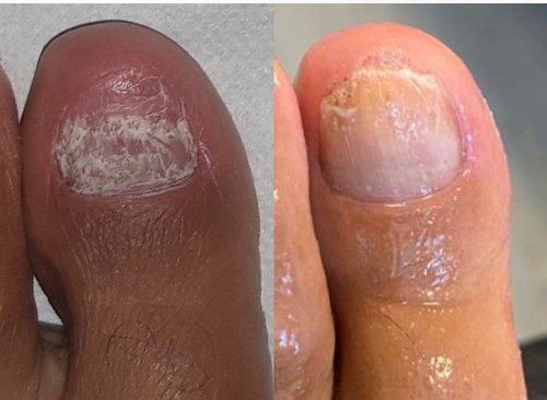 before and after laser nail.jpg