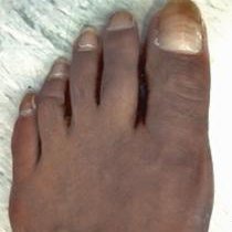 bunion-after-surgery-210-234.jpg
