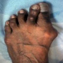 bunion-before-surgery-210-234.jpg