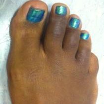 corn-after-surgery-210-234.jpg