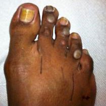 corn-before-surgery-210-234.jpg