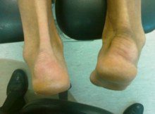 haglunds_deformity.jpg