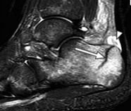 heel-stress-fracture-186-157.jpg