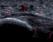 plantar-fasciitis-ultrasound-186-149.jpg